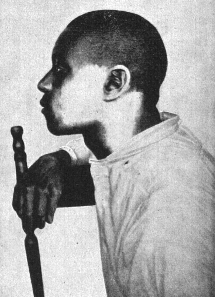 zobrazit detail historického snímku: Výsledak bílení pletl černochů pomoci Röntgen-nových paprsků.